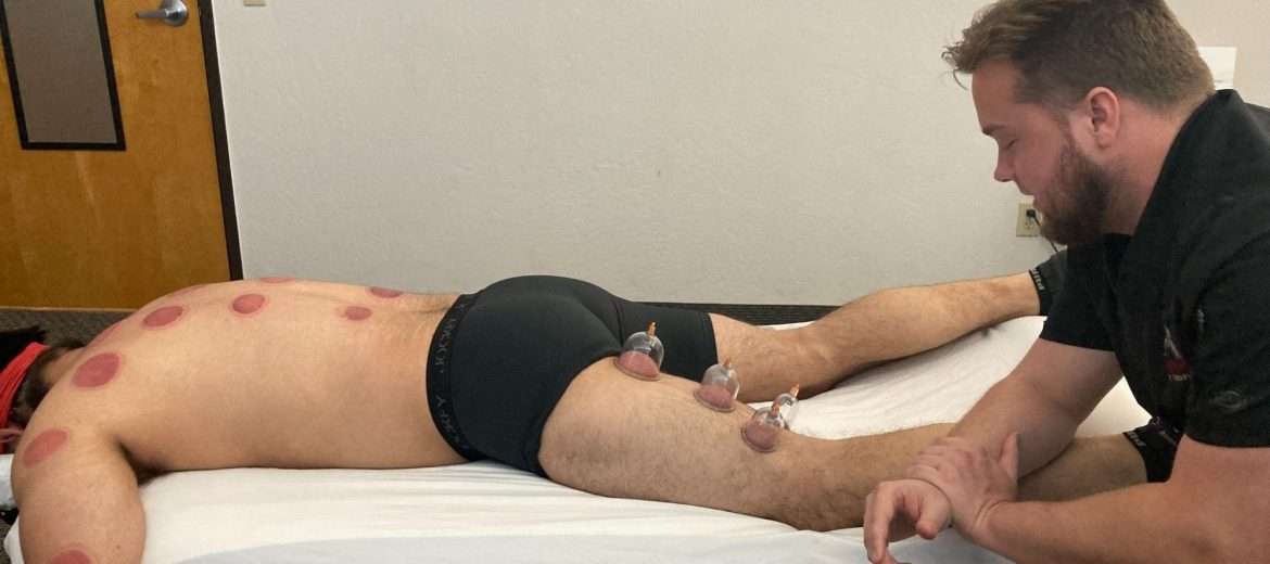 Myofascial cupping therapy improving tissue mobility and circulation