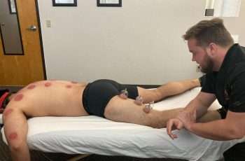 Myofascial cupping therapy improving tissue mobility and circulation