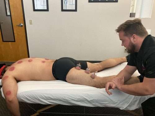 Myofascial cupping therapy improving tissue mobility and circulation